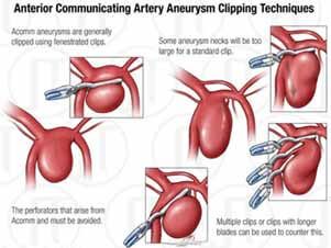 Aneurysm Clipping Procedure