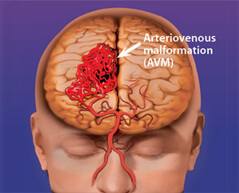arteriovenous malformation(AVM)