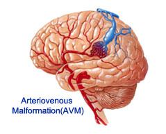 arteriovenous-malformation-surgery