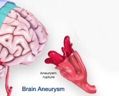 brain aneurysm raptured