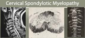 cervical-spondylotic-myelopathy