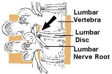 disc prolapse