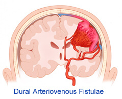 dural arteriovenous fistulae