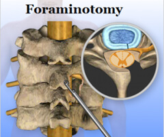foraminotomy surgery in india