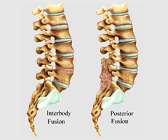 interior andposterior spine fusion surgery in india