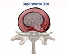 low cost degenerative disc disease surgery in india