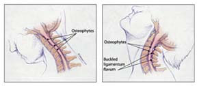 Cervical Spondylotic Myelopathy