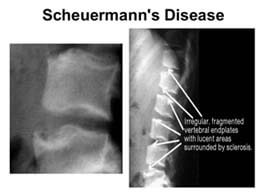 scheuermann disease