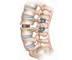 spinal fusion surgery in india