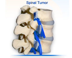 Spinal Tumors surgery in india