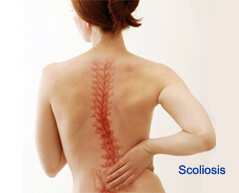 scoliosis surgery in india