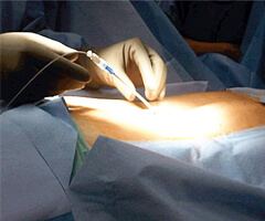 stimulator implant surgery in india
