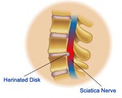 top sciatica treatment hospitals best specialists India