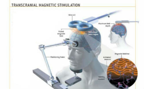 transcranial-magnetic-stimulation