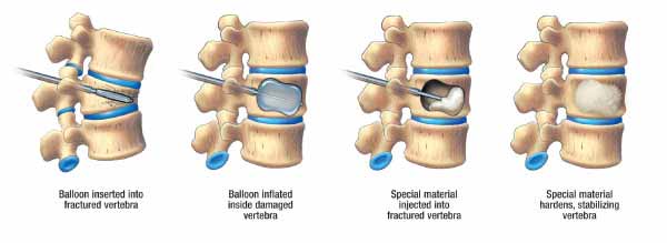 vertebroplasty and kyphoplasty procedure india