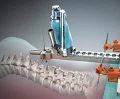 Best Place for Robotic Spine Treatment India