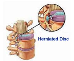 Herniated Disc Surgery in India