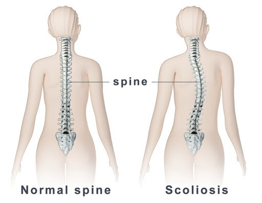 scoliosis and normal spine