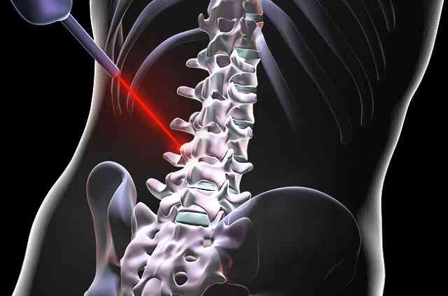 Laser Spine Surgery