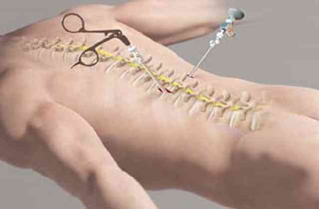 minimally invasive spine surgery