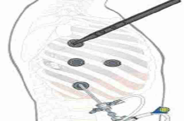 thoracoscopic anterior release