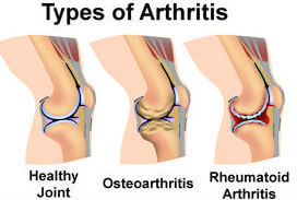 arthritis