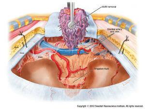 Embolisation