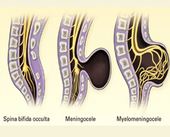 Spina bifida surgery in india