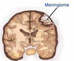 جراحة ورم في الدماغ بأسعار معقولة في الهند