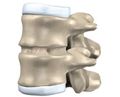 anterior lumbar interbody fusion surgery in india