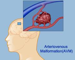 arteriovenous malformation treatment top specialists best hospitals India