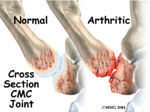arthritis osteoarthritis