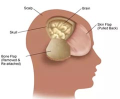 Super chirurgie de craniotomie pour les tumeurs du cul