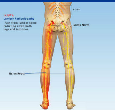 bilateral lumber radiculopathy