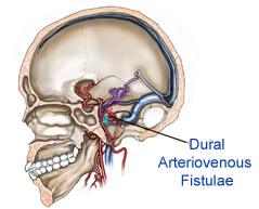 brain dural arteriovenous fistulae
