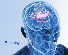 brain epilepsy