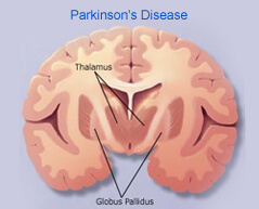 brain parkinson s disease