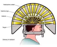 cost of radiation therapy for brain tumor in India