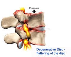 Degenerative Disc Disease Treatment | Spine & Neuro Surgery Hospital India 
