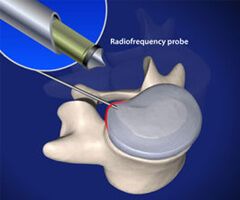 disc nucleoplasty