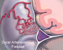 dural arteriovenous fistulae brain