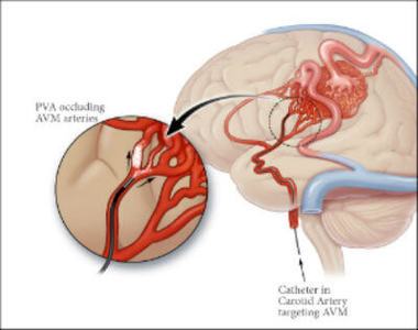 Embolisation