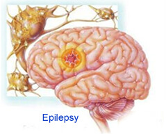 brain epilepsy