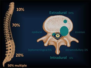 Metastasis to Spine - What You should Know!