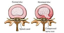 herniation