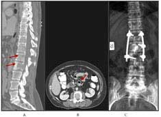 Metastasis to Spine - What You should Know!