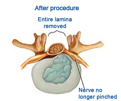 laminectomy Surgery in India