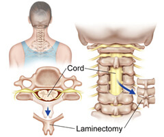 laminectomy Treatement in India