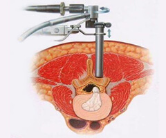 micro endoscopic discectomy treatment in india