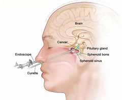 Chirurgie mini-invasive en trou de serrure pour tumeurs au cerveau